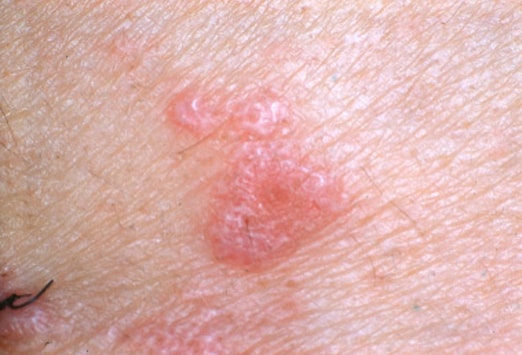 Gribok des Nagels die Temperatur 37
