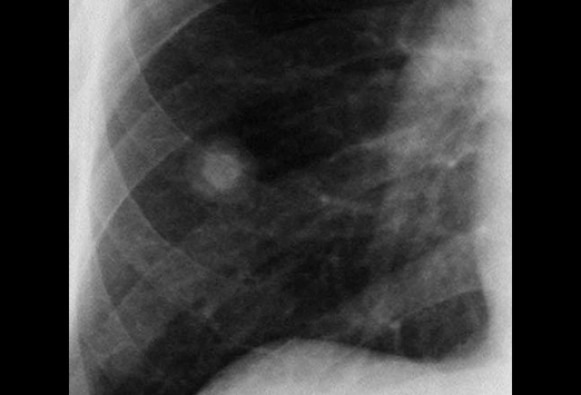Differenzialdiagnose Lungenkrebs | Medscape Deutschland